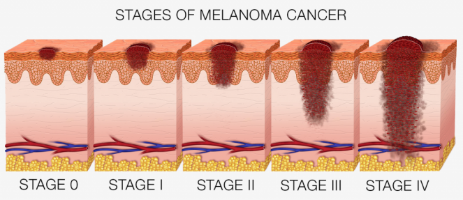 Melanoma or Skin Cancer: Where to Find Treatment in Toronto ...
