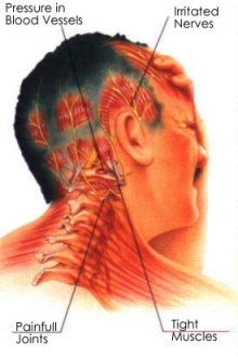 Do You Suffer from Migraine? Treatment Options in Toronto - VisitDoctor.ca